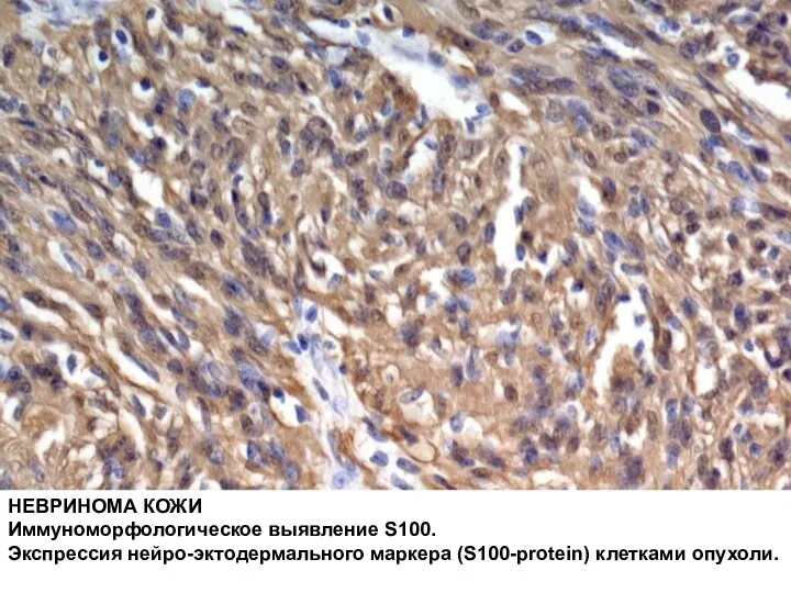 НЕВРИНОМА КОЖИ Иммуноморфологическое выявление S100. Экспрессия нейро-эктодермального маркера (S100-protein) клетками опухоли.
