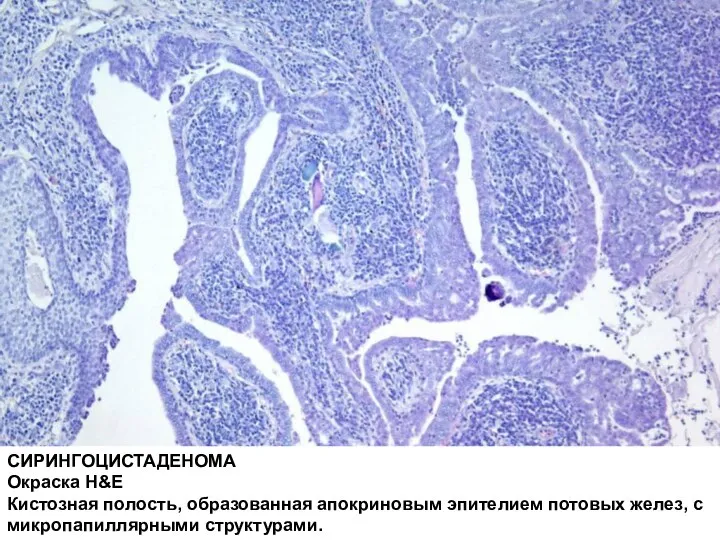 СИРИНГОЦИСТАДЕНОМА Окраска H&E Кистозная полость, образованная апокриновым эпителием потовых желез, с микропапиллярными структурами.