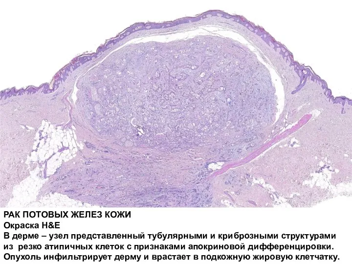 РАК ПОТОВЫХ ЖЕЛЕЗ КОЖИ Окраска H&E В дерме – узел представленный тубулярными