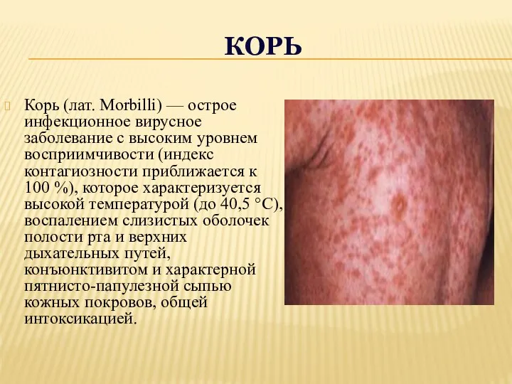 КОРЬ Корь (лат. Morbilli) — острое инфекционное вирусное заболевание с высоким уровнем
