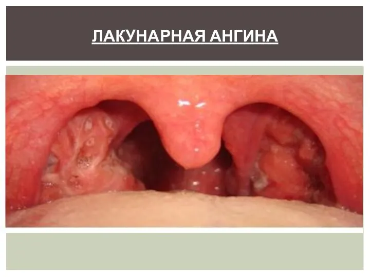 ЛАКУНАРНАЯ АНГИНА