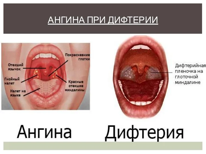 АНГИНА ПРИ ДИФТЕРИИ