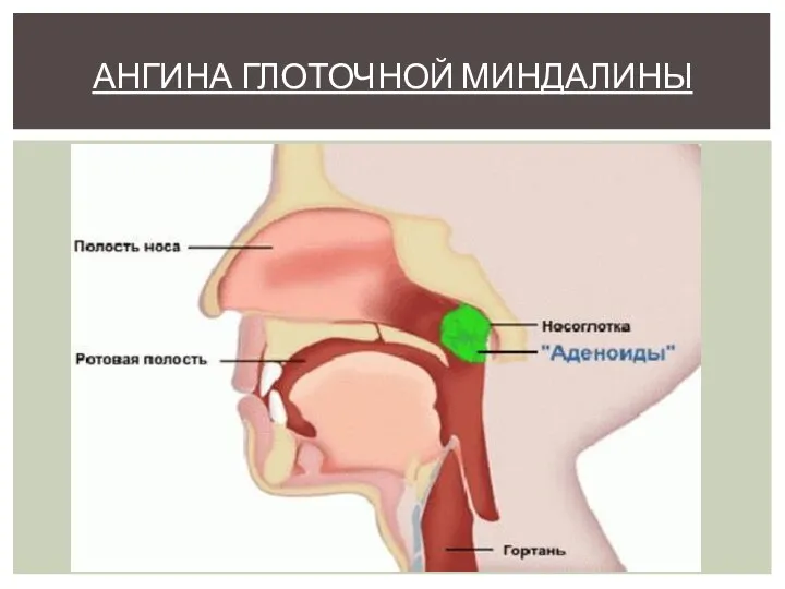 АНГИНА ГЛОТОЧНОЙ МИНДАЛИНЫ