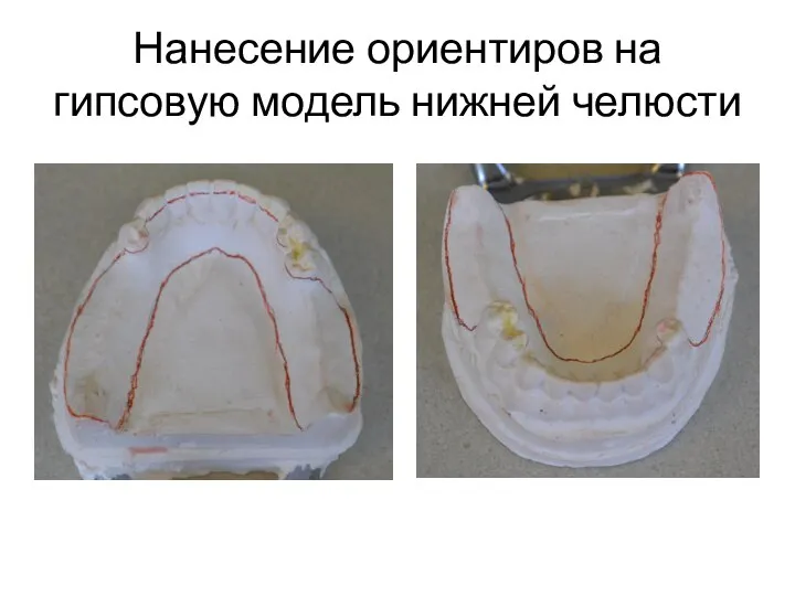 Нанесение ориентиров на гипсовую модель нижней челюсти