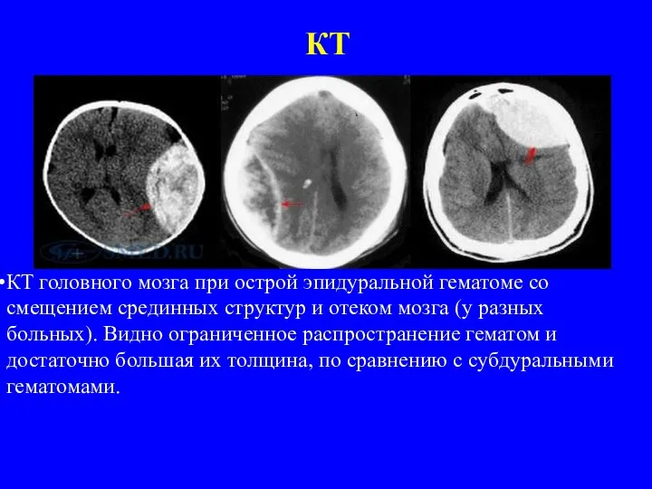 КТ КТ головного мозга при острой эпидуральной гематоме со смещением срединных структур