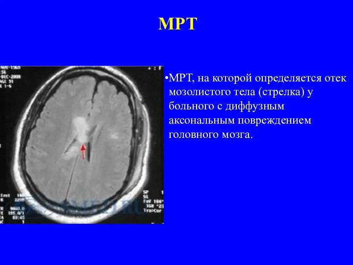 МРТ МРТ, на которой определяется отек мозолистого тела (стрелка) у больного с