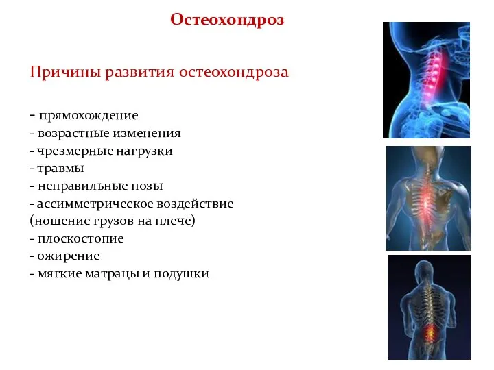 Остеохондроз Причины развития остеохондроза - прямохождение - возрастные изменения - чрезмерные нагрузки