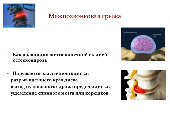 Межпозвонковая грыжа Как правило является конечной стадией остеохондроза Нарушается эластичность диска, разрыв