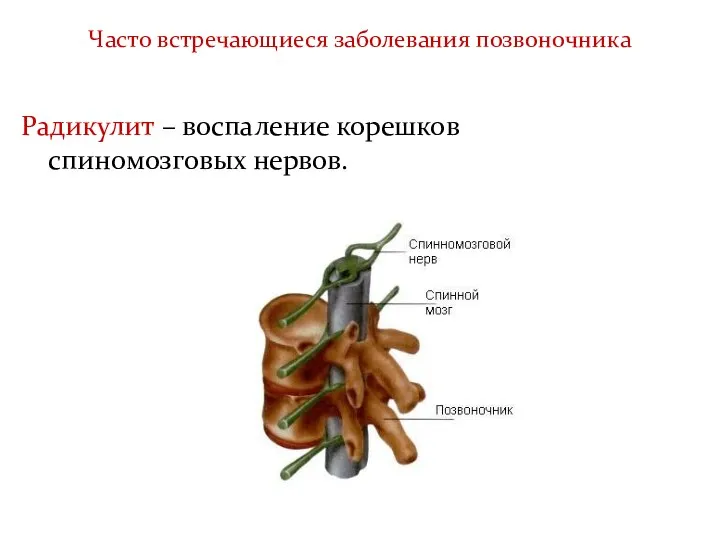 Часто встречающиеся заболевания позвоночника Радикулит – воспаление корешков спиномозговых нервов.