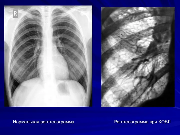 Нормальная рентгенограмма Рентгенограмма при ХОБЛ