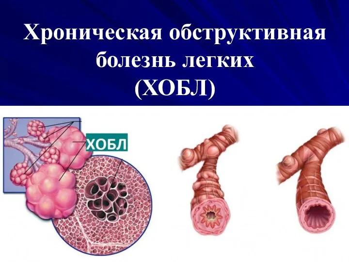 Хроническая обструктивная болезнь легких (ХОБЛ)