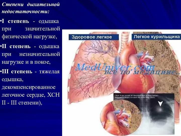 Степени дыхательной недостаточности: I степень - одышка при значительной физической нагрузке, II