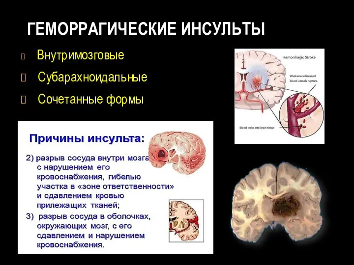 ГЕМОРРАГИЧЕСКИЕ ИНСУЛЬТЫ Внутримозговые Субарахноидальные Сочетанные формы