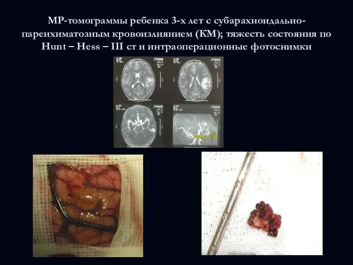 МР-томограммы ребенка 3-х лет с субарахноидально-паренхиматозным кровоизлиянием (КМ); тяжесть состояния по Hunt
