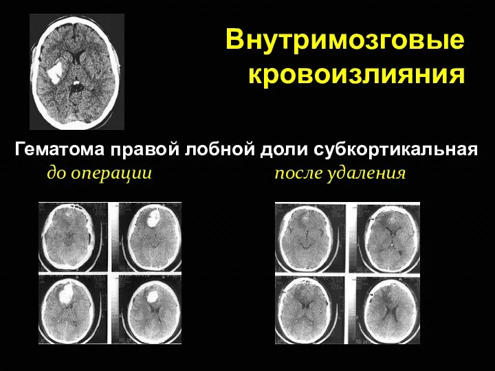 Внутримозговые кровоизлияния Гематома правой лобной доли субкортикальная до операции после удаления