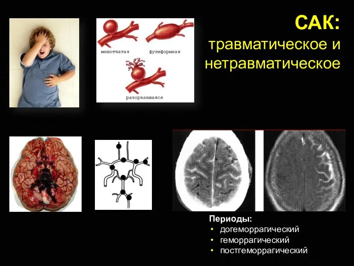 САК: травматическое и нетравматическое Периоды: догеморрагический геморрагический постгеморрагический