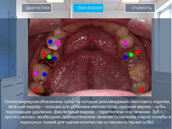 ПЛАН ЛЕНИЯ СТОИМОСТЬ ПЛАН ЛЕЧЕНИЯ ДИАГНОСТИКА Синим маркером обозначены зубы, на которые