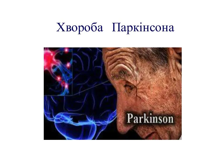Хвороба Паркінсона