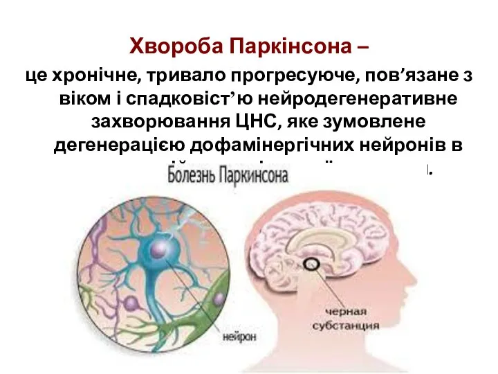 Хвороба Паркінсона – це хронічне, тривало прогресуюче, пов’язане з віком і спадковіст’ю