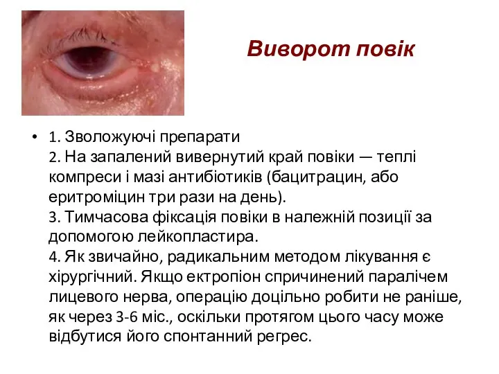 Виворот повік 1. Зволожуючі препарати 2. На запалений вивернутий край повіки —