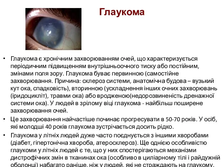 Глаукома є хронічним захворюванням очей, що характеризується періодичним підвищенням внутрішньоочного тиску або