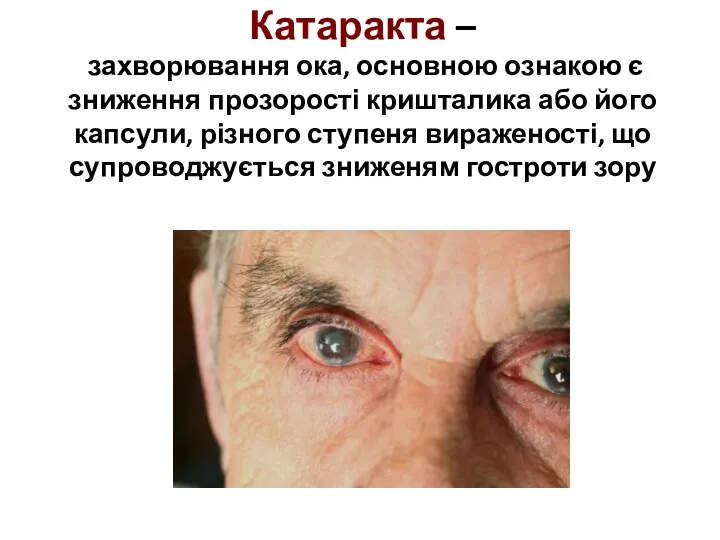 Катаракта – захворювання ока, основною ознакою є зниження прозорості кришталика або його