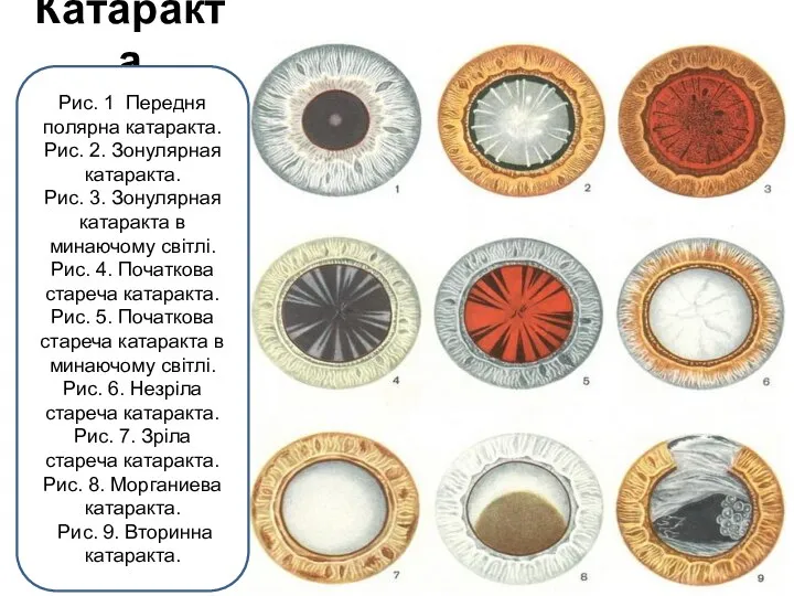 Катаракта Рис. 1. Передня полярна катаракта. Рис. 2. Зонулярная катаракта. Рис. 3.