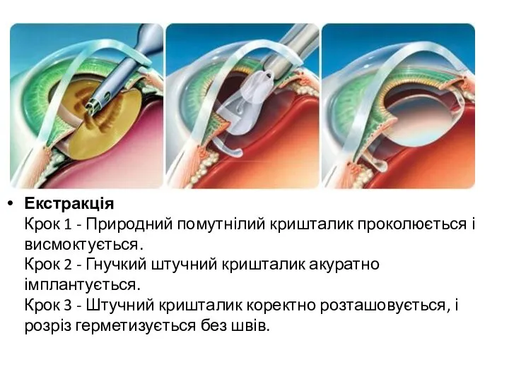 Екстракція Крок 1 - Природний помутнілий кришталик проколюється і висмоктується. Крок 2