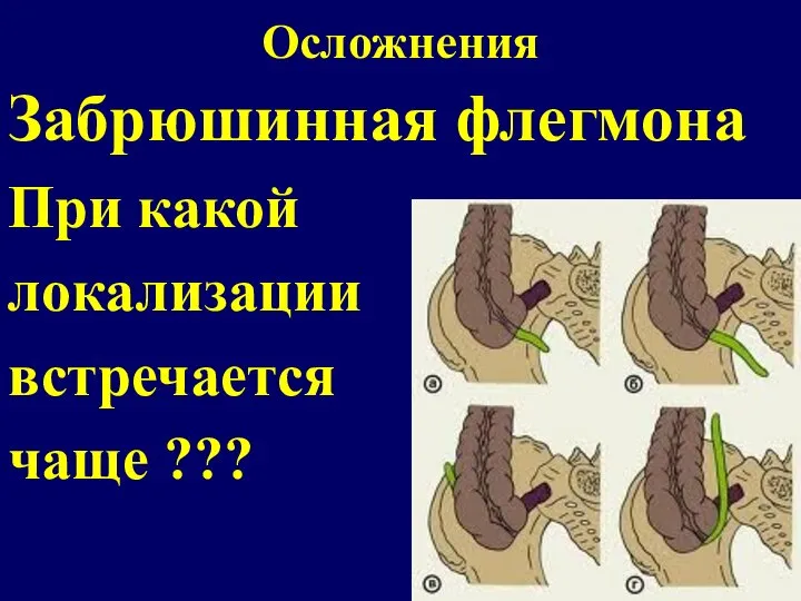 Осложнения Забрюшинная флегмона При какой локализации встречается чаще ???