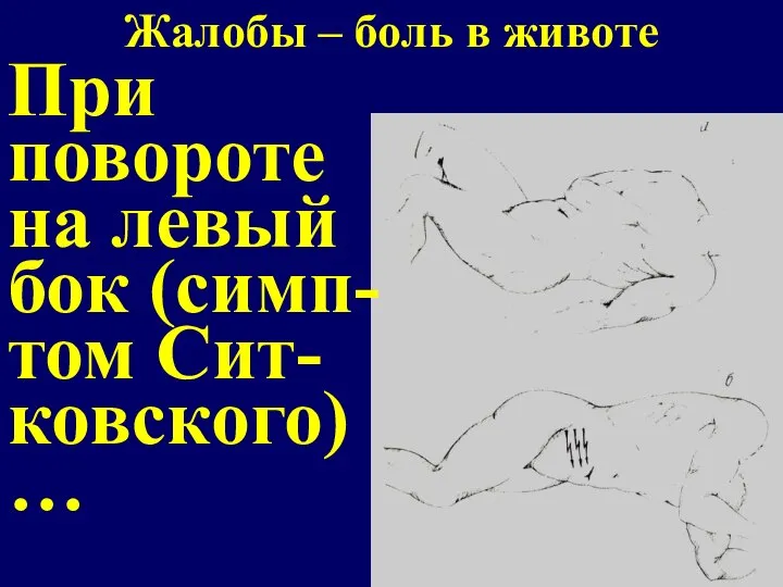 Жалобы – боль в животе При повороте на левый бок (симп- том Сит- ковского) …