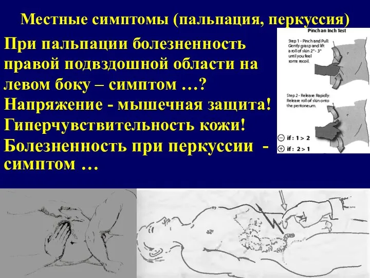 Местные симптомы (пальпация, перкуссия) При пальпации болезненность правой подвздошной области на левом