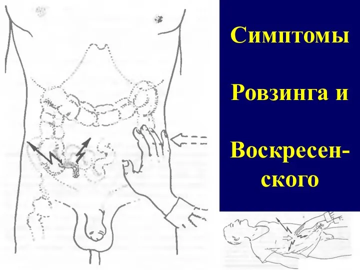 Симптомы Ровзинга и Воскресен-ского