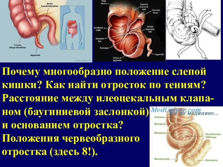 Почему многообразно положение слепой кишки? Как найти отросток по тениям? Расстояние между