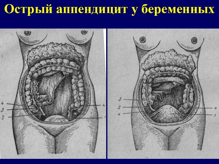 Острый аппендицит у беременных