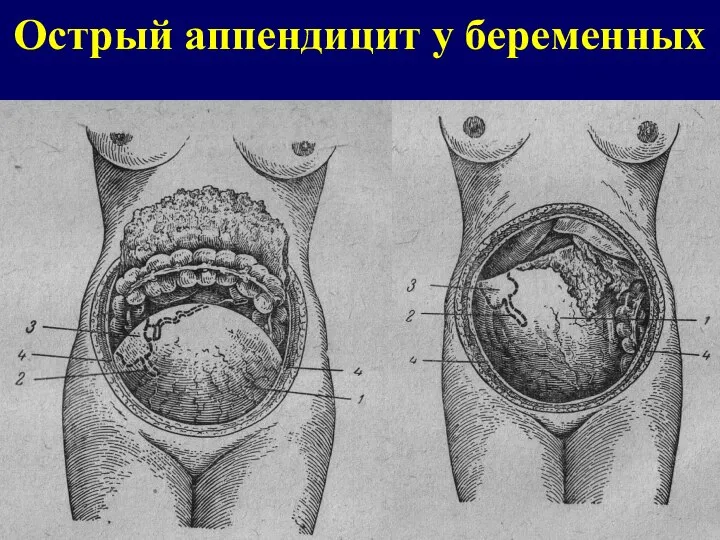 Острый аппендицит у беременных