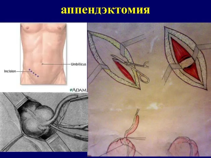 аппендэктомия