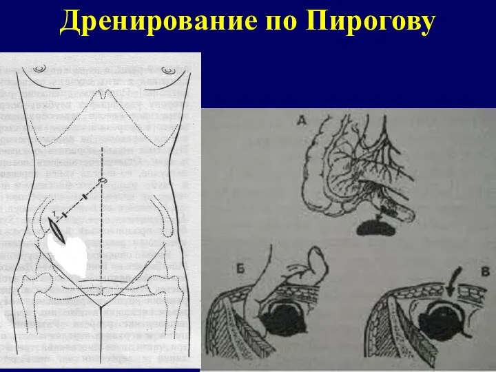 Дренирование по Пирогову