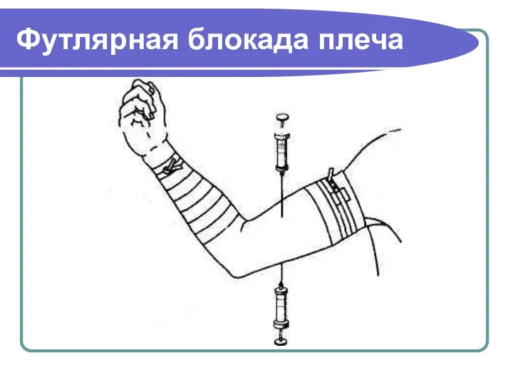 Футлярная блокада плеча