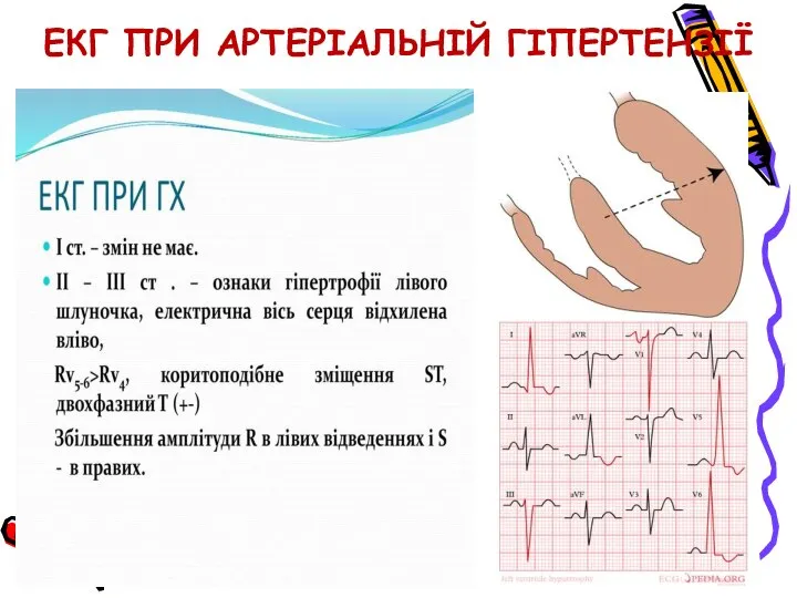 ЕКГ ПРИ АРТЕРІАЛЬНІЙ ГІПЕРТЕНЗІЇ