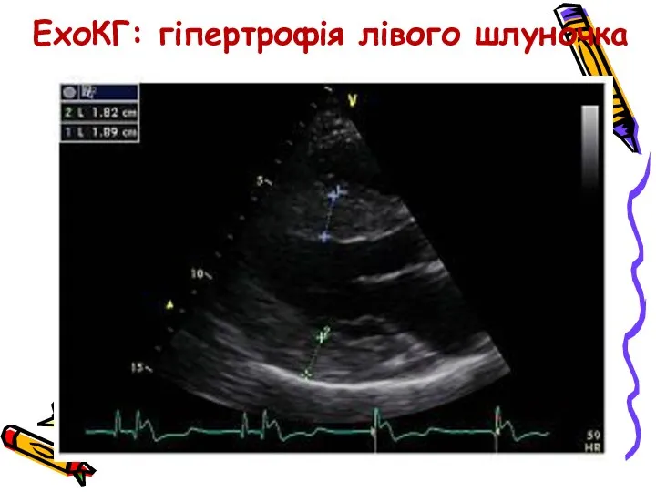 ЕхоКГ: гіпертрофія лівого шлуночка