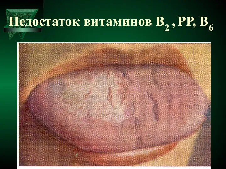 Недостаток витаминов В2 , РР, В6