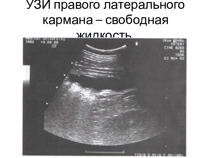 УЗИ правого латерального кармана – свободная жидкость.