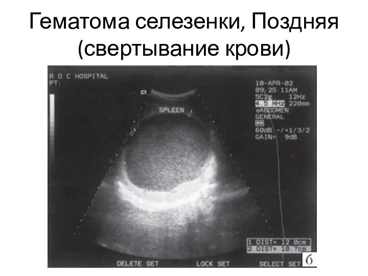 Гематома селезенки, Поздняя (свертывание крови)