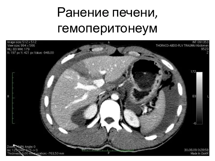 Ранение печени, гемоперитонеум