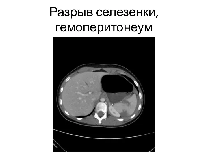 Разрыв селезенки, гемоперитонеум