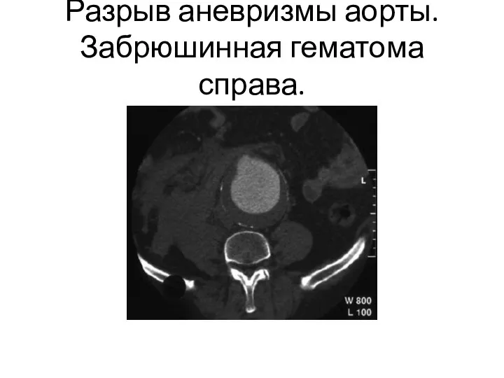 Разрыв аневризмы аорты. Забрюшинная гематома справа.