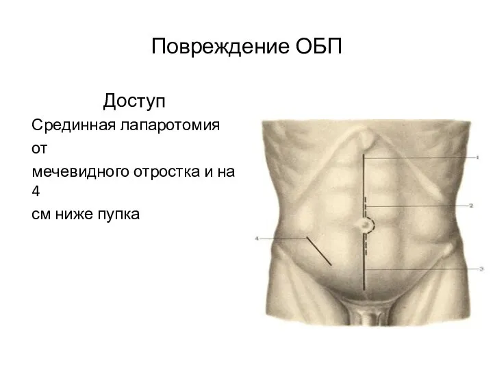 Повреждение ОБП Доступ Срединная лапаротомия от мечевидного отростка и на 4 см ниже пупка