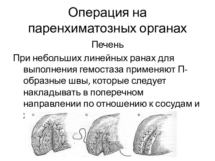 Операция на паренхиматозных органах Печень При небольших линейных ранах для выполнения гемостаза