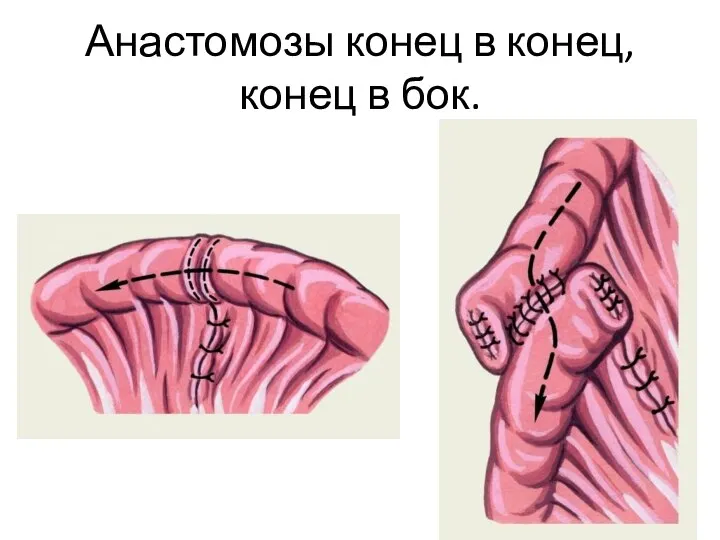 Анастомозы конец в конец, конец в бок.