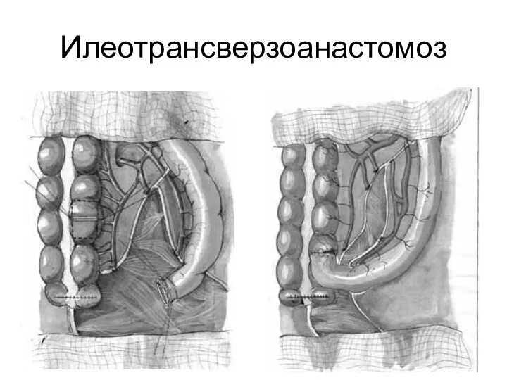 Илеотрансверзоанастомоз